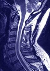 Magnetic resonance image of the cervical spine